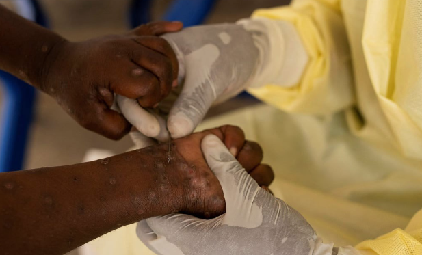 Le Sénégal renforce la surveillance sanitaire pour prévenir la propagation du virus mpox