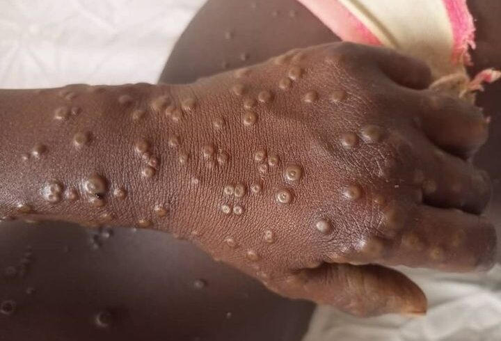 Mpox au Sénégal: 53 cas suspects ont été testés négatifs