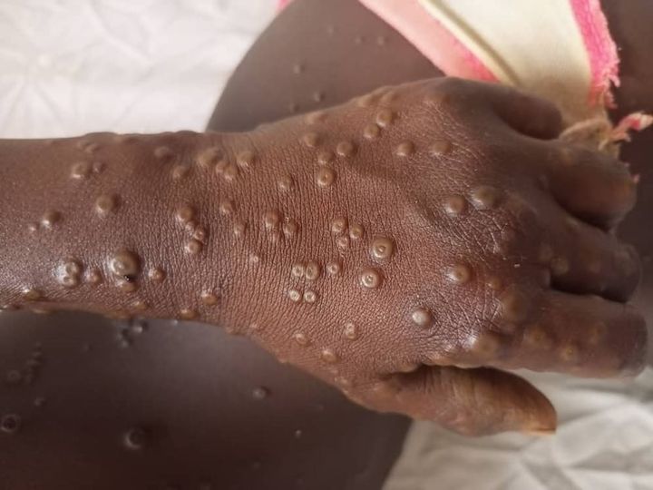 Mpox au Sénégal: 53 cas suspects ont été testés négatifs